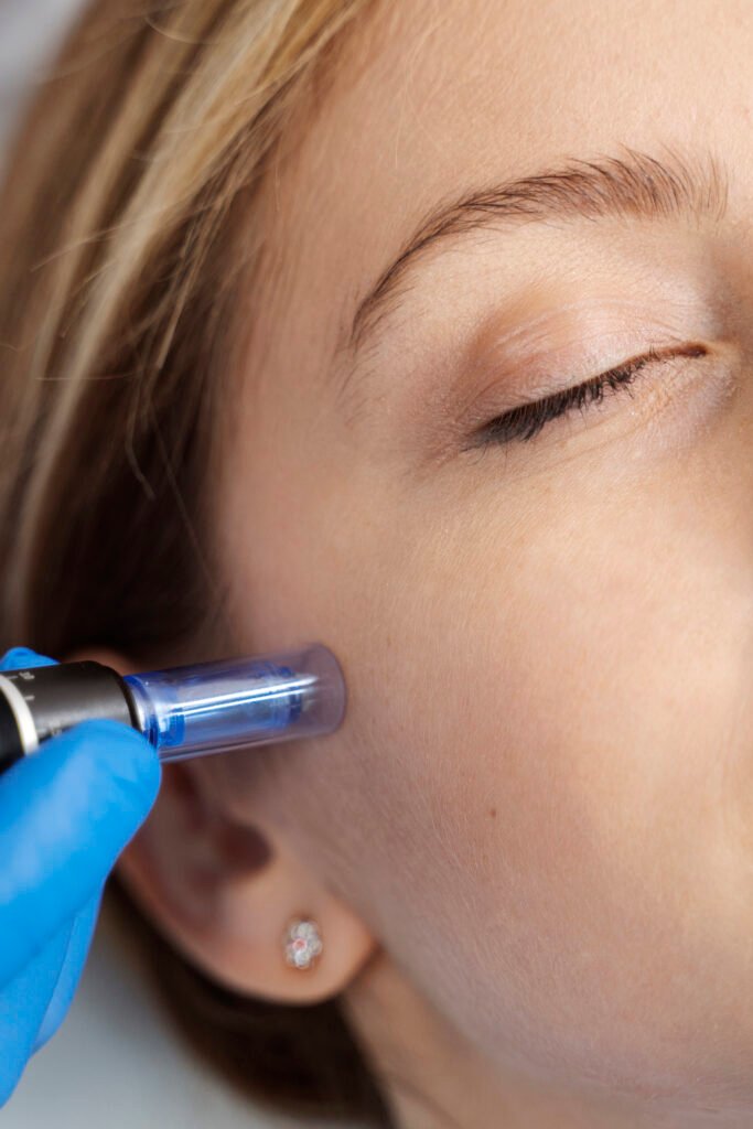 patient-undergoing-microneedling-procedure